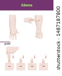 medical illustration of edema... | Shutterstock . vector #1487187800