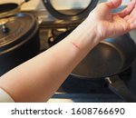 Small photo of Close up of heat burn scar on woman's arm. Wounds caused by scald while cooking with heated pan at kitchen. Background with kitchen items