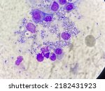 Small photo of Bone marrow aspirate showed yeast like organisms in the bone marrow. The organisms were elongated with a characteristic clear central septation, morphologically consistent with Penicillium marneffei.