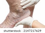 Small photo of Doctor in white gloves holding man's foot and pointing to varicose veins, deep vein thrombosis, venous injuries on foot. Healthy varicose ulcer. Isolated on white background.