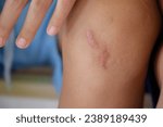 Small photo of Scar is inflamed and red called keloids on children knee close-up in body parts blurred background concept of skin and wound for medical healthy skin care.