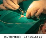 Small photo of Baby´s umbilical cord being catheterize. Female doctor´s hand with gloves and baby covered with sterile green cloth. Neonatology. NICU.
