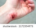 Small photo of Red wound on the palm, arm, wrist after a burn or fall. First aid in wound treatment. Treatment of wounds. Extreme close up of a red skin burn