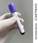 Edta test tube anticoaglant cbc ...