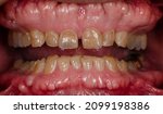 Small photo of The teeth erosion and large exostosis in oral cavity ( torus )