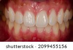 Small photo of The natural teeth and gum recession of left upper lateral incisor