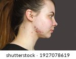 Small photo of Red pimples on the skin of a young girl close-up. Acne on the face of a teenage girl. Problems and treatment of acne in young people. Skin rashes, allergies. Keloids. The concept of puberty.