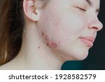 Small photo of Pimples on the skin of a young girl close-up. Acne on the face of a teenage girl. Problems and treatment of acne in young people. Skin rashes, allergies. Keloids. The medical concept is puberty.