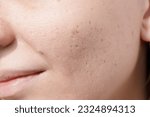 Small photo of Young woman suffering from problem skin and acne closeup. Icepick scars acne on cheek