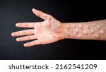 Small photo of MONKEYPOX. The arm is blistered from monkeypox. Virus, epidemic, disease. Black background.