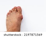Small photo of A bunion on the toe joint after successive gout attacks. Gout bunion.