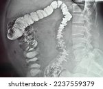 X Ray Picture Of Intestinal...