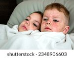 Small photo of Natural vaccination between brother and sister. Contagious disease. Sick child with chickenpox. Varicella virus or Chickenpox bubble rash on child body and face. High quality photo