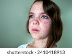 Small photo of Natural vaccination. Contagious disease. Sick child with chickenpox. Varicella virus or Chickenpox bubble rash on child body and face. High quality photo.