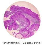 Small photo of Photomicrograph of an sinonasal inverted papilloma (SNIP), a benign tumor that may occur in the nasal cavity or paranasal sinuses. 40X