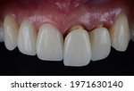 Small photo of Placing all ceramic crown to mask darken teeth for esthetic reason, All ceramic zirconia crowns were placed in the mouth to whiten the smile.