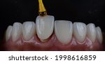 Small photo of Placing all ceramic crown to cover darken front teeth. Close up intra oral macro shot.
