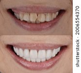 Small photo of Complete smile makeover from darken teeth and crooked teeth to white and well aligned smile.