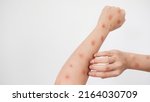 Small photo of Concept of epidemic of monkey pox virus, white woman scratching skin, red rash, pustules and abscess, itching after being infected with monkeypox virus.