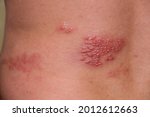 A Man Has Herpes Zoster. Red...