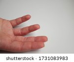 Small photo of Hand with interdigital dermatitis that goes to the dermatologist for edema, itching, pain and suppuration