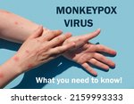 Small photo of Phrase MONKEYPOX VIRUS what you need to know. Monkeypox new disease dangerous over the world. Patient with Monkey Pox. Painful rash, red spots blisters. Close up human hands with Health problem