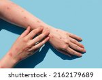 Small photo of Monkeypox new disease dangerous over the world. Patient with Monkey Pox. Painful rash, red spots blisters on the hand. Close up rash, human hands with Health problem. Banner, copy space