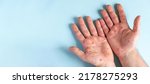 Small photo of Male hands with Monkeypox rash. Patient with MonkeyPox viral disease. Close Up of Painful rash, red spots blisters on the skin. Human palm with Health problem. Banner, copy space. Allergy, dermatitis