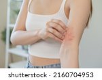 Small photo of Dermatology asian young woman, girl allergy, allergic reaction from atopic, insect bites on her arm, hand in scratching itchy, itch red spot or rash of skin. Healthcare, treatment of beauty.