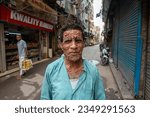 Small photo of Old Delhi, India-13 Aug 2023: A happy man suffering with rare skin disease, skin covered with thousands of small tumour across her body.
