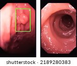 Small photo of Endoscope technology concept. 3d rendering endoscopic inside of intestine gastric polyp.