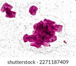 Small photo of Pap's smear microscopic showing severe inflammatory epithelial cells with reactive cellular changes and rods shape bacilli. NILM. cervical cancer diagnosis.