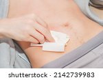 Small photo of The hand of a caucasian young man is pressed with a sterile dry napkin on the small intestine brought out on the stomach, top view .Concept step-by-step replacement of a colostomy bug at home, abdomin