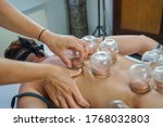 Small photo of It's a photo about bonesetters and suction cups medecin