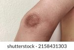 Small photo of portrait showing crook of the arm, problem black elbow of the woman, concept health care.