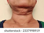 Small photo of portrait the flabbiness adipose sagging skin, Wrinkles and Flabby skin under the neck, wattle and cellulite under the chin of the woman, the mole on the body, health care and beauty concept.