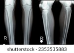 Small photo of Plain X ray of both right and left knee joints with lower part of femur and upper parts of tibia and fibula and patella showing normal knee join of a young male that complains painful joint for MRI