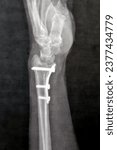 Small photo of Plain x ray showing a recent fissure fracture at the lower part of a left radius bone, also showing a previous internal fixation of the wrist join with plate and screws of a previous fracture
