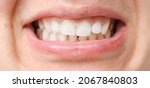 Small photo of Mouth with white teeth, malocclusion, health problem. Close-up occlusion, misalignment.