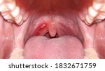 Small photo of Close up on a canker sores. Inflammation of oral cavity. Very painful aphthae on uvula or soft palate. Really disturbing mouth ulcers. Anatomy of a inflamed buccal cavity. Reddened buccal mucosa.
