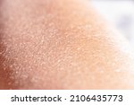 Small photo of Concept of extremely dry and dehydrated skin of the body. Problematic skin diagnosed with xerosi or dermatitis. Close up of chapped arms and legs. Selective focus of a itchy skin.