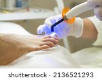 Small photo of An orthopedist puts a metal nail clamp on an ingrown toenail. It shines with an ultraviolet lamp to harden the glue. Correction of nail deformity.