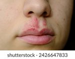 Small photo of close-up of a woman with herpes on her lip: vesicle and blister