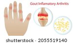 Illustration Of Gout Disease In ...