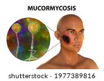 Cutaneous Mucormycosis  A...