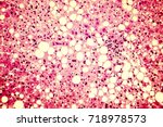 Small photo of Fatty liver, liver steatosis. Photomicrograph showing large vacuoles of triglyceride fat accumulated inside liver cells, it occurs in alcohol overuse, under action of toxins, in diabetes