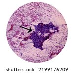 Small photo of Intra abdominal mass(Cytology): Spindle cell sarcoma, positive malignant cells. Pleomorphic undifferentiated sarcoma, malignant fibrous histiocytoma.