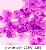 Small photo of Pap's smear. Microscopic examination of pap smear showing inflammatory smear with reactive cellular changes. NILM. cervical cancer diagnosis.
