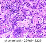 Small photo of Lung cancer - adenocarcinoma, mucinous type. Therapies for specific genetic mutations (biomarkers EGFR, ALK, ROS1, BRAF, PDL1, KRAS) are appropriate for selected cases.