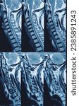 Small photo of MRI of Cervical Spine and screening. Cervical spondyloarthropathy, thecal sac indentation at C4-C5 and C5-C6 level, indentation with nerve roots compression at C5-C6 level.